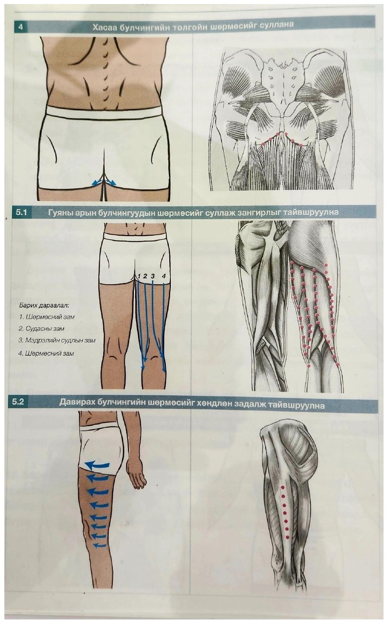 Trajets de baria sur la cuisse et le mollet, flèches de drainage